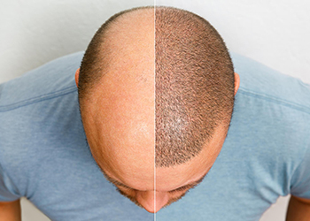 Hair Restoration | Hair Transplant | Cosmetic Treatment without Surgery
