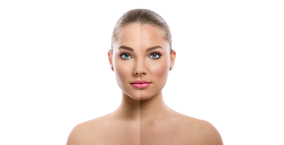 Chemical Peel Treatment for Sun-damaged Skin | Face Peel Treatment