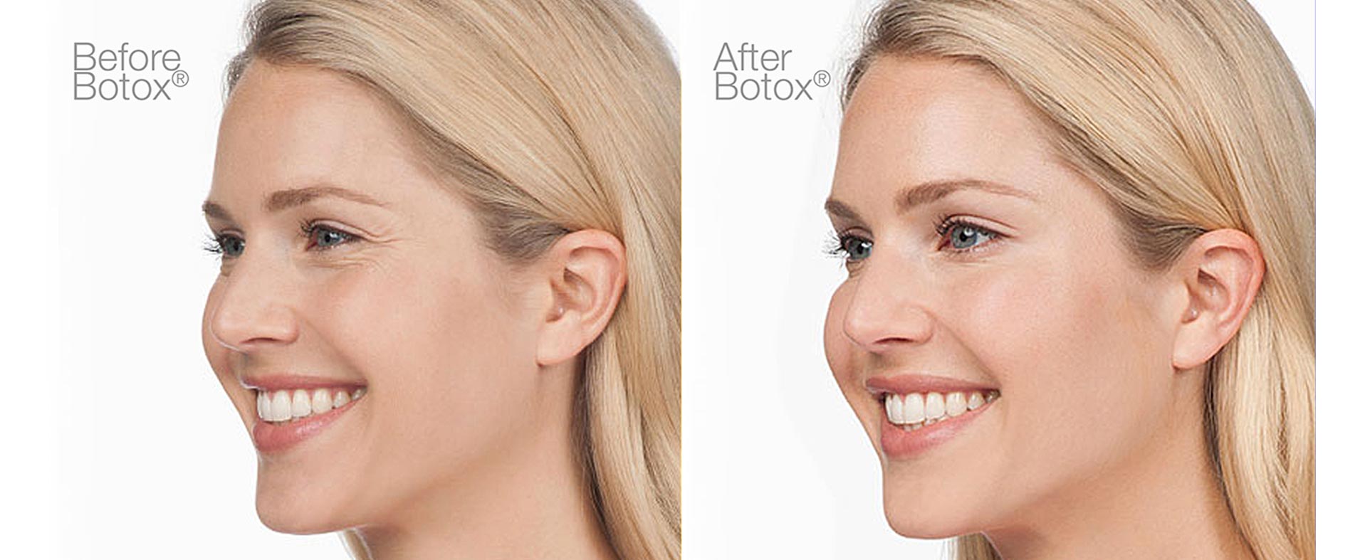 Botox injection before and after