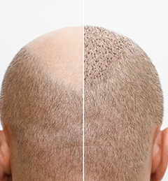 Hair Restoration | Hair Transplant in Coimbatore | Best Hair Transplantation Clinic