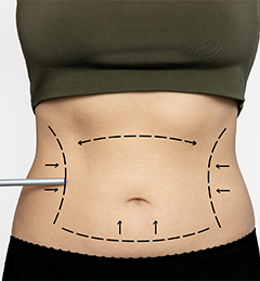 Liposuction | Fat Removal Treatment | Nova Cosmetic Surgery Centre
