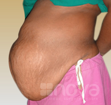 Before Treatment Photo | Abdominoplasty | Tummy Tuck Surgery Centre