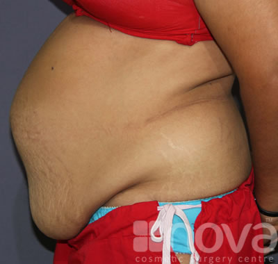 Abdominoplasty | Tummy Tuck Surgery | Before Treatment Photo