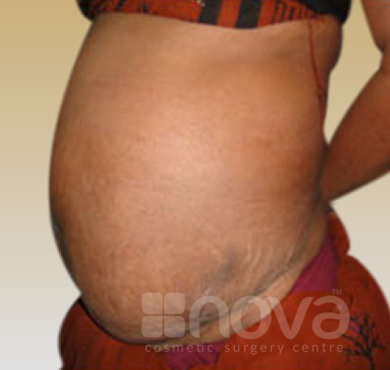 After Treatment Photo | Abdominoplasty | Tummy Tuck Surgery Centre