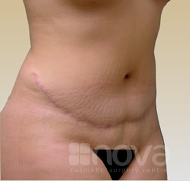 After the Abdominoplasty Treatment | Tummy Tuck Cosmetic Surgery Centre