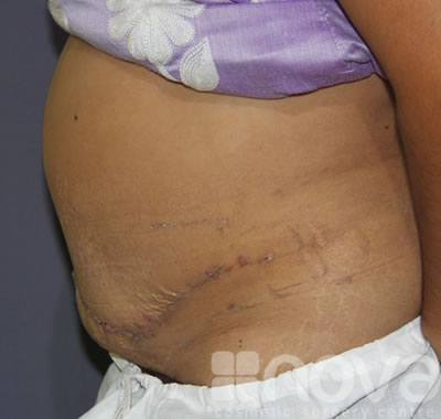 Abdominoplasty | Tummy Tuck Surgery | After Treatment Photo