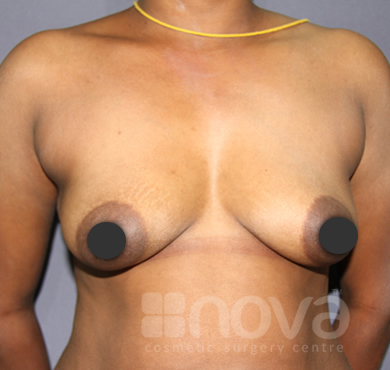 Before Breast Augumentation Photo | Breast Enlargement Treatment | Cosmetic Surgery Centre