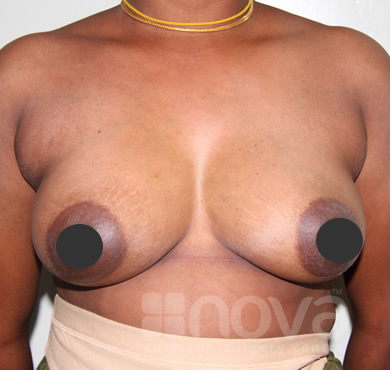 After Breast Augumentation Photo | Breast Enlargement Treatment | Cosmetic Surgery Centre