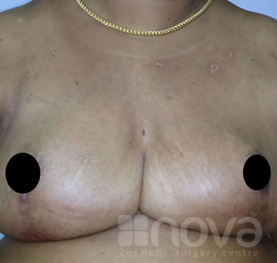 After Treatment Photos | Female Breast Reduction | Surgical Treatment