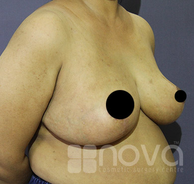 Female Breast Reduction Photos | Nova Cosmetic Surgery Clinic