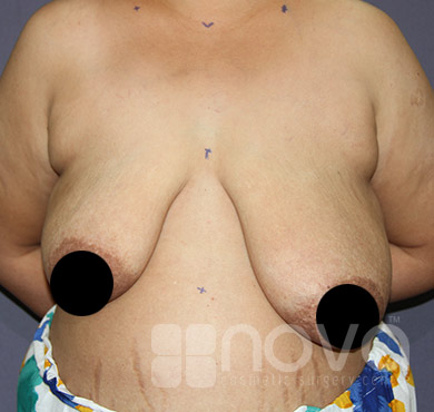 Before Female Breast Reduction Treatment Photos | Nova Cosmetic Surgery Centre
