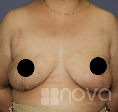 After Female Breast Reduction Treatment Photos | Nova Cosmetic Surgery Centre