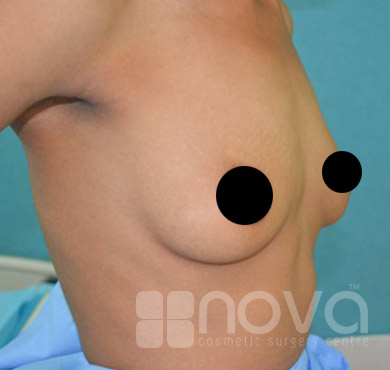 Before Breast Enlargement Treatment Photo | Increase the Breast Size | Cosmetic Surgery Clinic