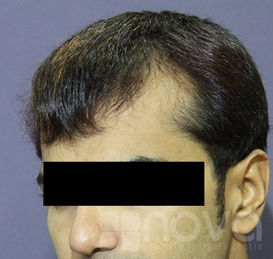 Hair Transplant | Before Treatment Photos | Cosmetic Surgery Centre