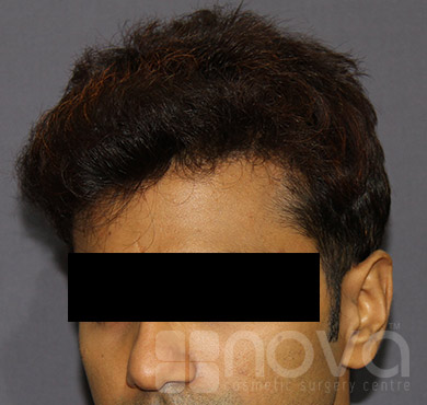 After Treatment Photos | Hair Transplant | Cosmetic Surgery Clinic