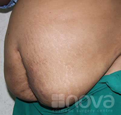 Liposuction Treatment | Before the surgery photo | Cosmetic Surgery Centre