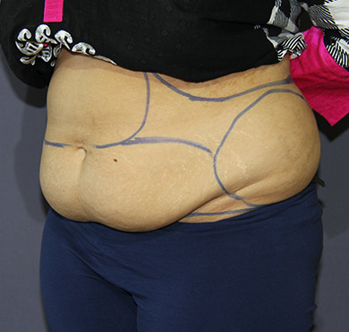 Liposuction Surgery for Belly Fat | Before Treatment Photo