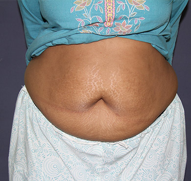 Liposuction Surgery for Abdomen | Before Treatment Photo | Cosmetic Surgery Clinic