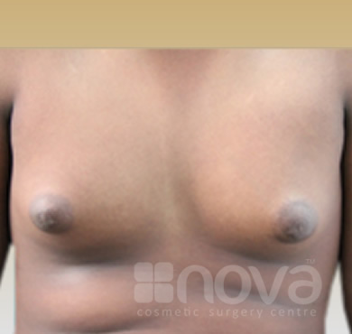 Gynecomastia | Male Breast Correction | Before the Treatment