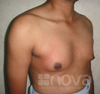 Male Breast Correction | Before the Treatment Photos | Gynecomastia