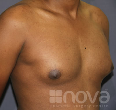 Gynecomastia | Before Treatment Photos | Male Breast Correction