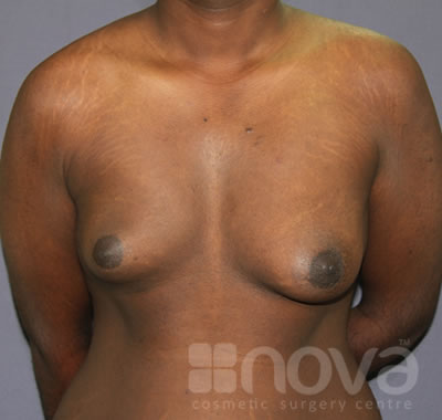 Before Gynecomastia Treatment Photos | Male Breast Correction | Cosmetic Surgery Clinic