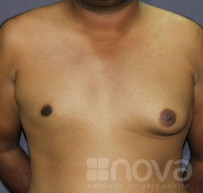 Gynecomastia | Male Breast Reduction | Nova Cosmetic Surgery Centre