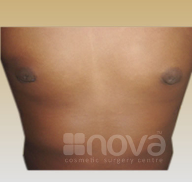Gynecomastia Treatment | Male Breast Correction & Reduction | After Treatment Photos