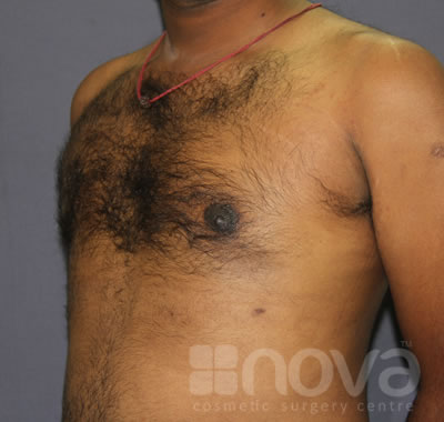 Gynecomastia | After Treatment Photo | Male Breast Reduction | Cosmetic Surgery Clinic
