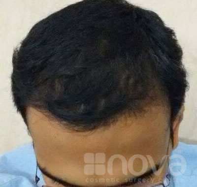 Hair Fixing Treatment Centre at Coimbatore | After Treatment photos