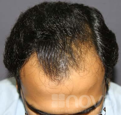 Hair Fixing Treatment Before Photos | Nova Cosmetic Surgery Centre