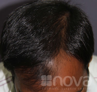 Hair Loss Treatment | Before Treatment Photos | Nova Cosmetic Surgery Centre
