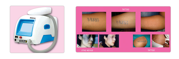 Laser Tattoo Removal, Permanent tattoo removal, Laser Mole Removal in  Coimbatore