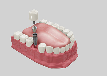 Surgical Cosmetic Dentistry | Dental Implants