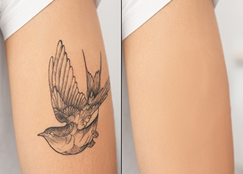 Laser Tattoo Removal | Permanent Tattoo and Mole Removal Treatment