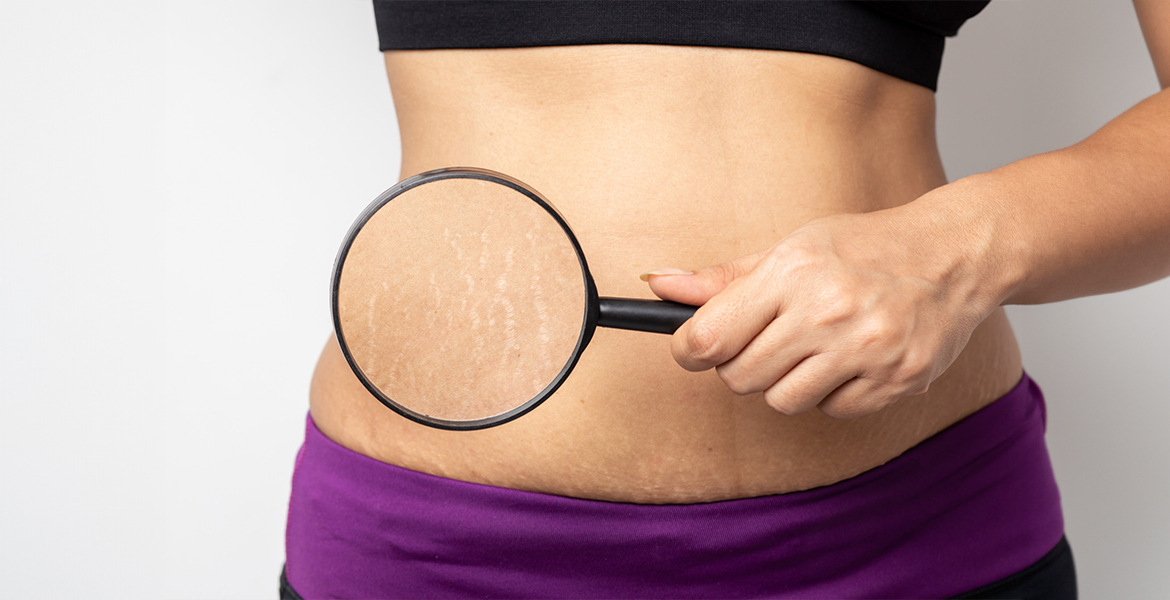 Laser Stretch Mark Removal | Stretch Mark Removal Clinic in Coimbatore