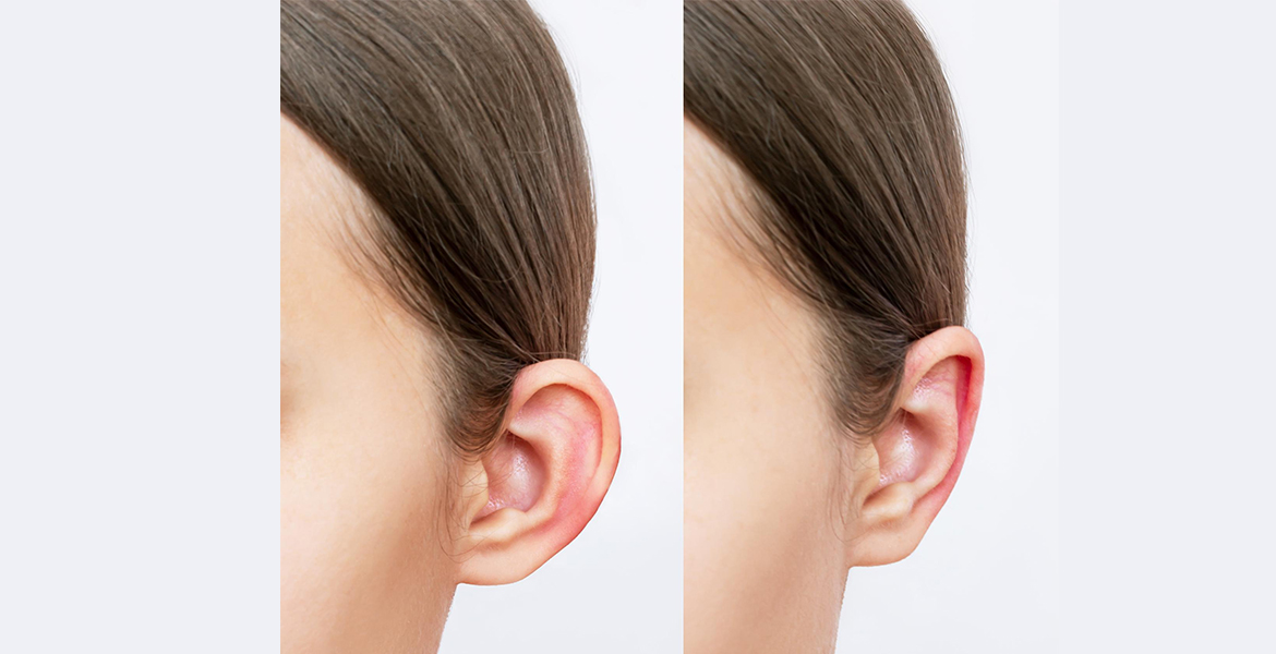 Ear Reshaping Surgery Treatment | Otoplasty | Cosmetic Ear Surgery