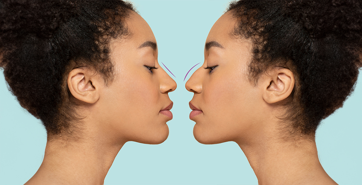 Rhinoplasty | Nose Reshaping Treatment | Rhinoplasty Surgery in Coimbatore