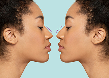 Rhinoplasty | Nose Reshaping Treatment | Nose Cosmetic Surgery in Coimbatore