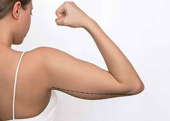 Arm Lifting | Arm Lift Surgery | Nova Cosmetic Surgery Centre in Coimbatore